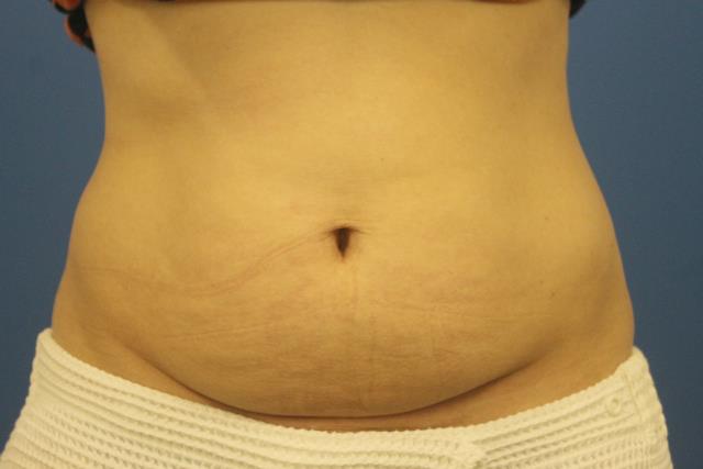 Lose Belly Fat with CoolSculpting London & Bucks