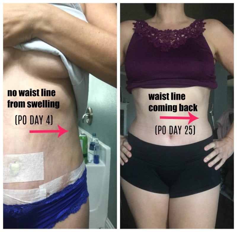 PICTURES: Swelling After Tummy Tuck! *Week by Week Recovery* - MomDot